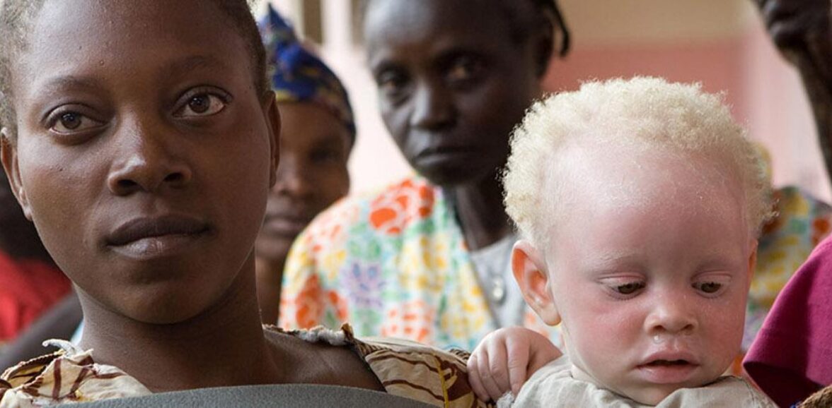 Día Internacional de Sensibilización sobre el Albinismo  – 13 de junio